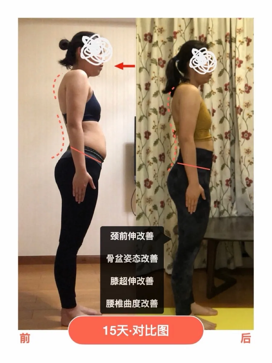 15 天 颈前伸 · 骨盆姿态
