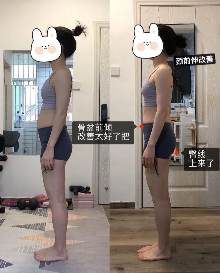 1 个月 骨盆前倾 · 臀线